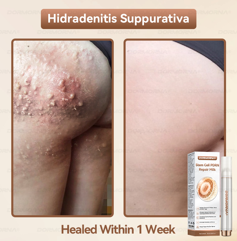 𝐷𝑂𝑅𝑀𝑂𝑅𝑁𝐴® 💕 Stem Cell PDRN Repair Milk | With 2000PPM Exosome‑Coated Micro‑Spicules 👩‍⚕️